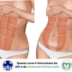 La Diastasi Addominale: Inquadramento Clinico e Approccio Multidisciplinare.