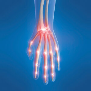 Riabilitazione della mano e del polso