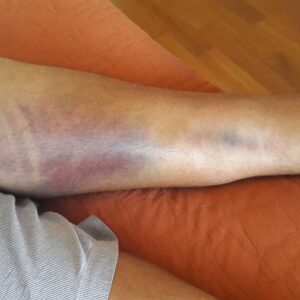 Le Lesioni Muscolari nello Sportivo: Eziopatogenesi Valutazione e Trattamento